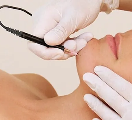 epilation laser définitive centre laser du parc wattignies docteur hima bentein