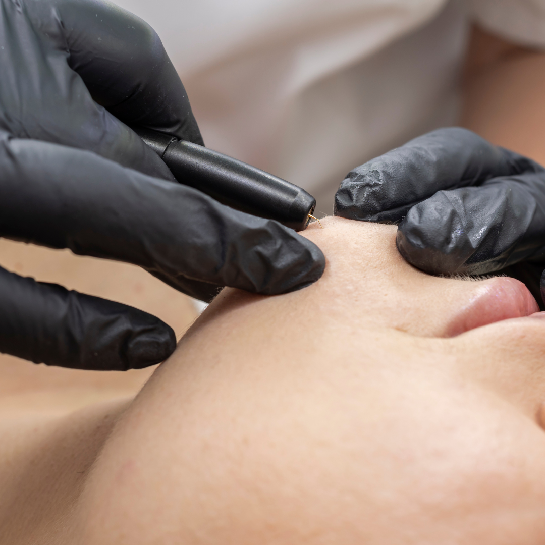 epilation laser définitive centre laser du parc wattignies docteur hima bentein